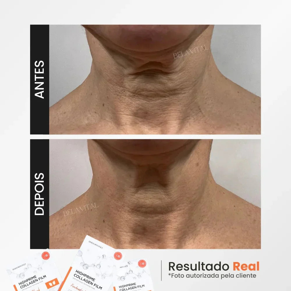 MÁSCARA DE COLÁGENO + ACIDO HIALURÓNICO + ACTIVO DE BOTOX - GOLDBOTOX