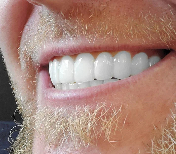 CARILLAS CERÁMICAS DENTALES KIT COMPLETO - SMILEFLEX™